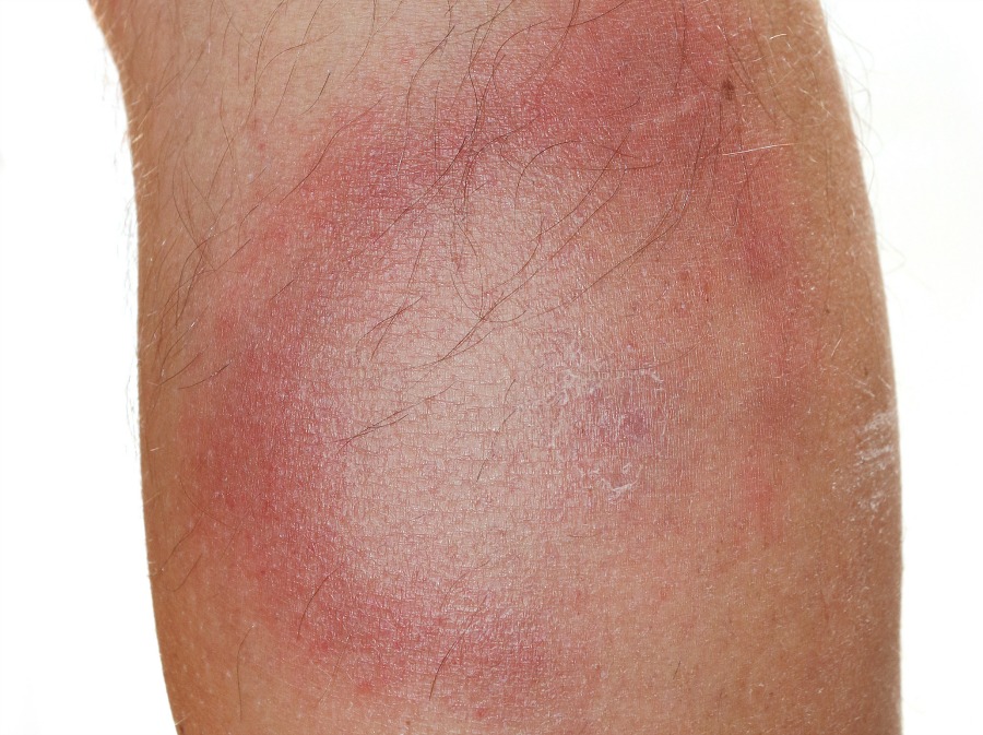 The tell-tale rash of Lyme disease.